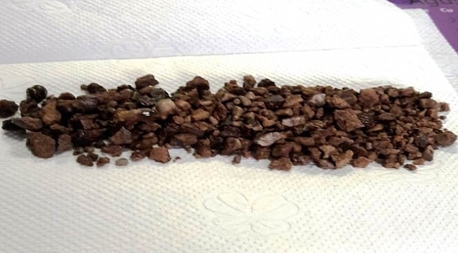 Böbreklerinde 500 adet taş çıktı