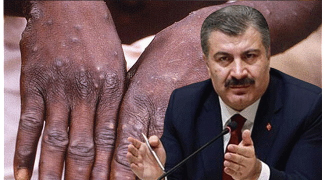  Sağlık Bakanı Fahrettin Koca: Türkiye'de 5 maymun çiçeği vakası tespit edildi
