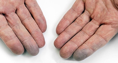 SOĞUK HAVALARLA TETİKLENEN REYNO HASTALIĞINA DİKKAT!