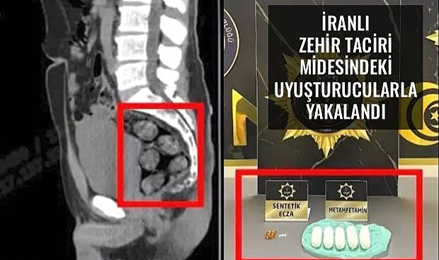 İranlı Zehir Taciri, Midesinde Uyuşturucu Taşıyarak Çanakkale'ye Geldi